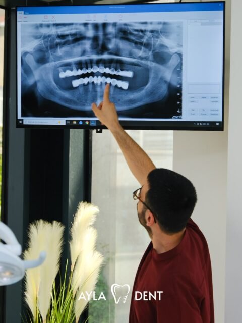 🦷 Doğru teşhis, başarılı tedavinin ilk adımıdır.
Her hastamızın hikâyesi farklıdır. Bu yüzden tedaviye başlamadan önce yalnızca diş filmlerini incelemiyor, aynı zamanda sizi dikkatle dinliyoruz.

📸 Bu karede hekimimiz, panoramik röntgen üzerinde mevcut durumu hastamıza detaylı bir şekilde anlatırken, yaşadığı şikayetleri de dinleyerek en doğru tedavi planını oluşturuyor.
Ayla Dent’te amacımız sadece tedavi etmek değil;
✔️ Sorunun kaynağını doğru belirlemek,
✔️ Size tüm süreci anlaşılır şekilde açıklamak,
✔️ Kişiye özel bir tedavi planı hazırlamaktır.
Çünkü güçlü bir iletişim, sağlıklı bir gülüşün temelidir.😊

⚠️ Önemli Bilgilendirme 
Bu içerik genel bilgilendirme amacıyla hazırlanmıştır. Kişiye özel tanı ve tedavi planlaması yalnızca muayene sonrasında, ilgili alanda yetkin diş hekimi tarafından yapılabilir.

📞 0(212) 890 11 22 
🌐 www.ayladentistanbul.com 
📍 Yavuz Selim Mahallesi, Birlik Caddesi, No:89 Bağcılar, İstanbul

#AylaDent #DişKliniği #BağcılarDişKliniği #İstanbulDişKliniği #SağlıklıGülüş