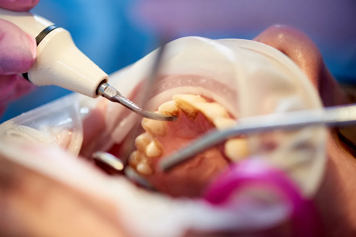 Bağcılar Ayla Dent klinikte ultrasonik cihazla diş taşı temizliği uygulaması