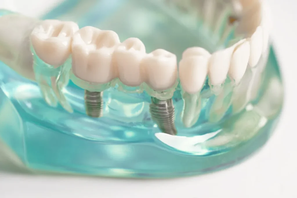Çene kemiğine yerleştirilmiş diş implantı modeli