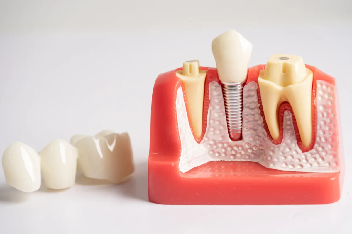 Çene modeli üzerinde implant ve kuron örnekleri