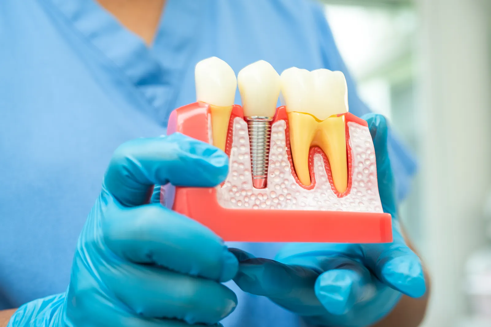Eldivenli diş hekimi diş implantı kesit modelini tutuyor: vida şeklindeki titanyum implant ve üzerindeki kuron